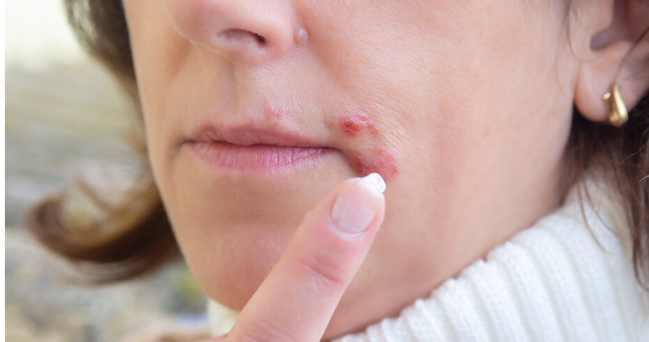 herpes-on-the-lips-part-of-a-woman-s-face-with-fi-2025-02-02-20-23-49-utc (2)