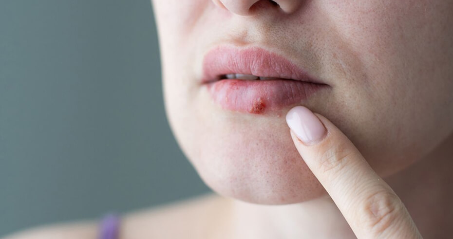 woman cold sores (1)